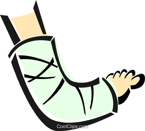 Arm Cast Cliparts - Broken Arm Clip Art.