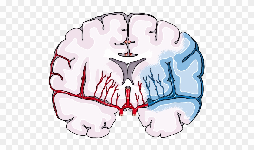 Ischemic stroke. Инсульт cartoon. Stroke Types.