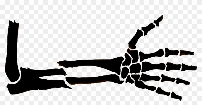 Bone Fracture Arm Drawing Clavicle Clip Art - Broken Arm Clip Art #613841