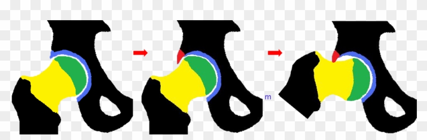 “cam Impingement” Occurs When A Non Spherical Femoral - “cam Impingement” Occurs When A Non Spherical Femoral #838188