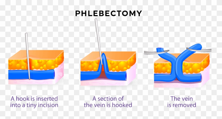 Request A Free Consultation Or Call Us At 296-4030 - Ambulatory Phlebectomy #1021002