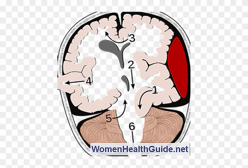 การเพิกถอนสมอง - Hernias - Brain Herniation #1036600