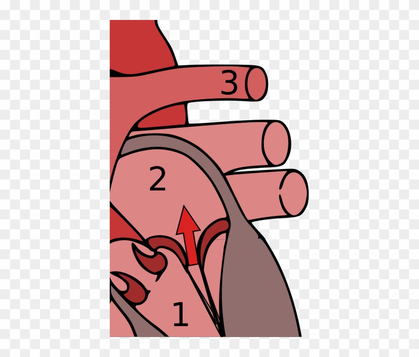 Mitral Valve Prolapse Can Result In Mitral Regurgitation, - Mitral Valve Prolapse #1074510