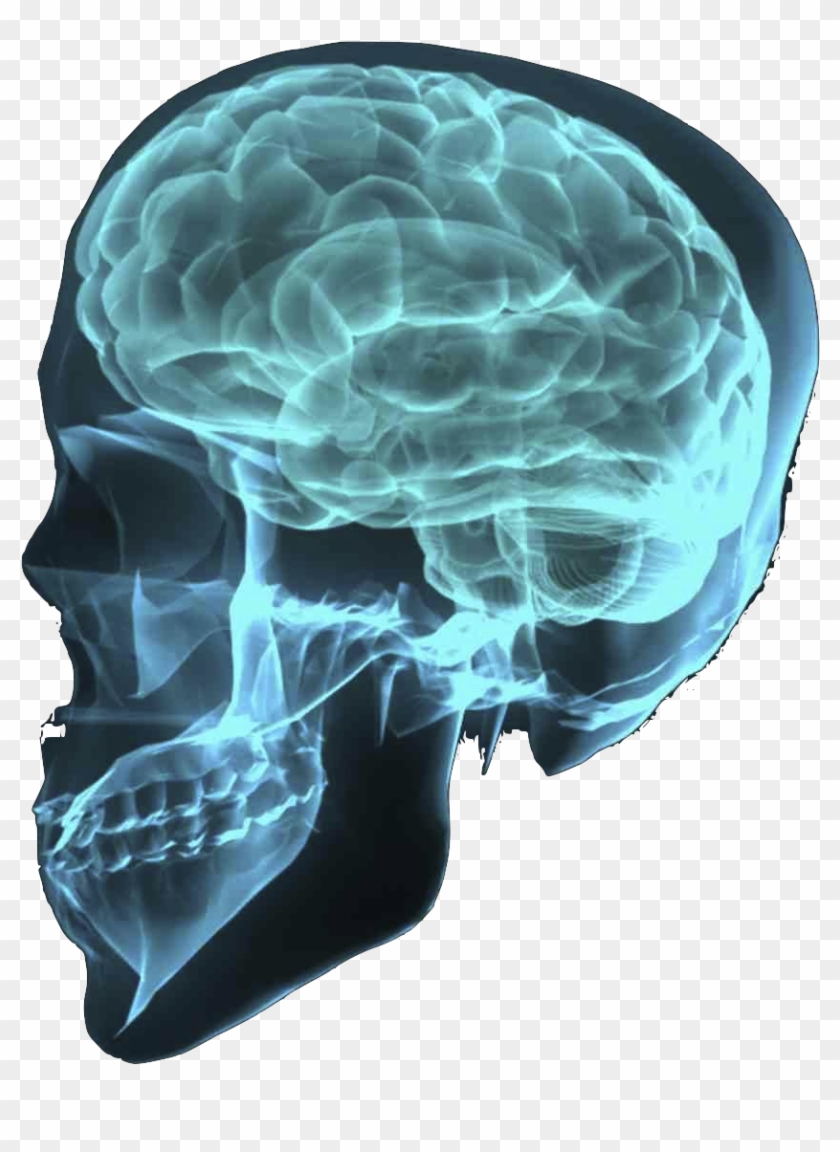 Skull Brain Cut Out Png - Back From Brain Aneurysm #1079134