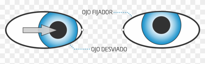 Endotropia - Estrabismo Convergente - Estrabismo Endotropia #1201623