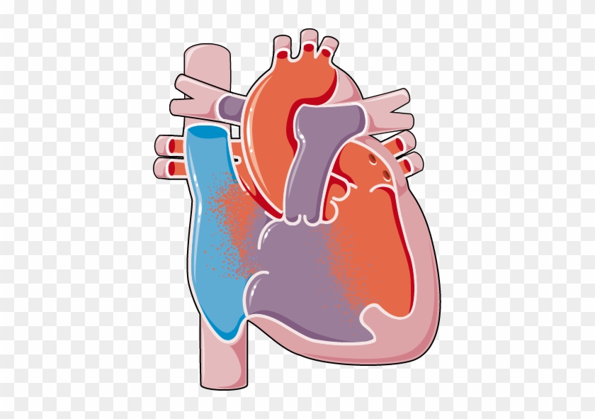 Congenital Heart Diseases Atrioventricular Canal Defect - Birth Defect #1217343