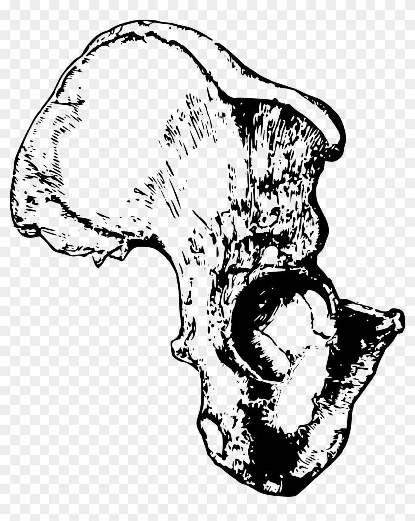 Синостоз тазовой кости