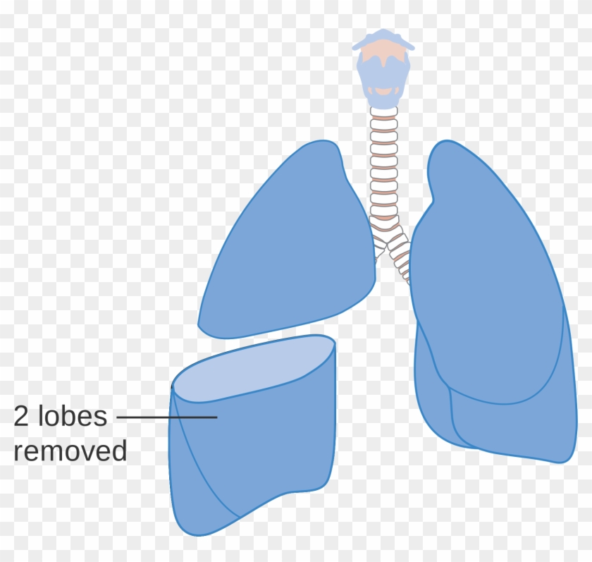 Open - Bilobectomy Lung #1434579