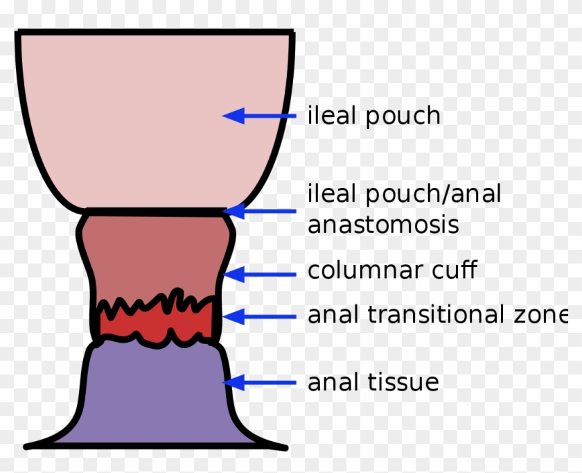 Ileoanal Anastomosis Rectal Cuff #1435010