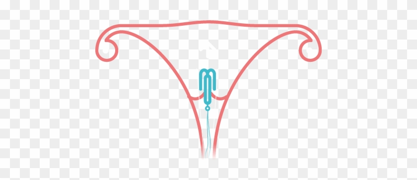 A Clinician Will Insert The Small, T-shaped Plastic - A Clinician Will Insert The Small, T-shaped Plastic #1517868