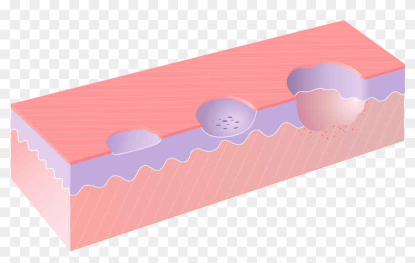 Erosion Excoriation Ulcer - Excoriation Vs Ulcer #1596518