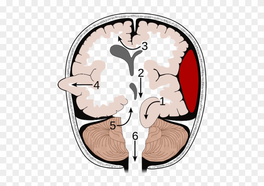 Alzheimer Disease Symptoms Screenshot 1 Alzheimer Disease - Types Of Brain Herniation #1689937