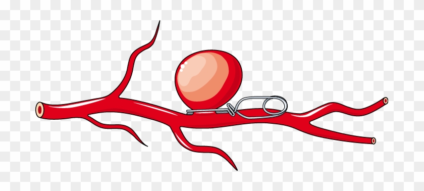 Servier Medical Art - Aneurysm Clip Art #321337