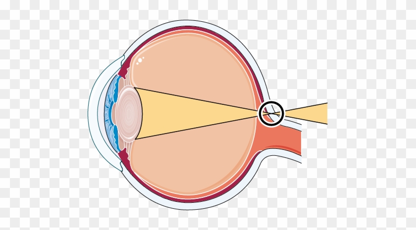 Long-sighted Eye - Astigmatism #427623